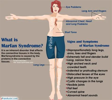 syndrome de marfan -- photo|select all of the characteristics marfan syndrome.